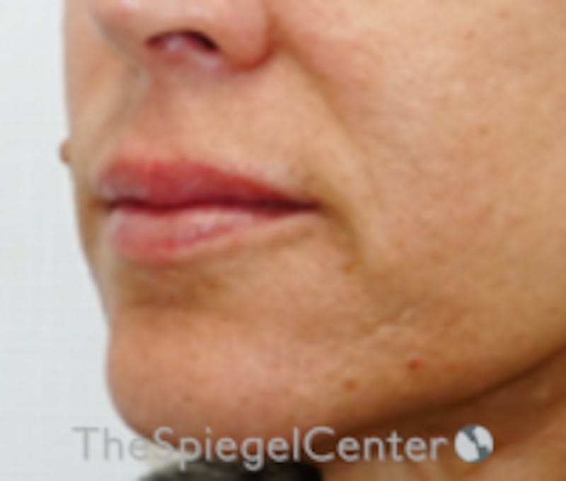 Lip Filler Before & After Gallery - Patient 157140904 - Image 3