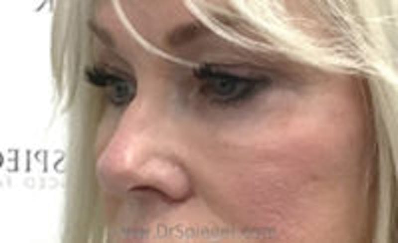Tear Trough / Under Eye Fillers Before & After Gallery - Patient 157140903 - Image 4