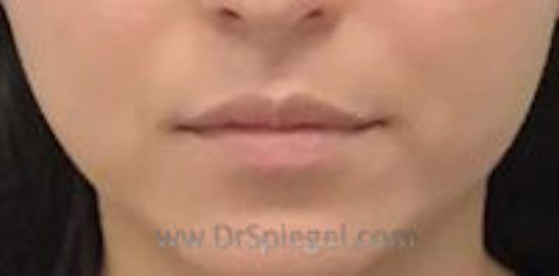 Lip Filler Before & After Gallery - Patient 157140910 - Image 1