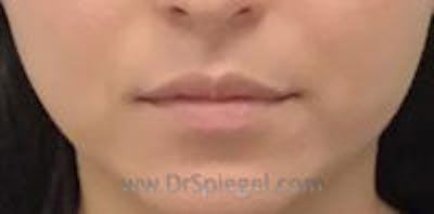 Lip Filler Before & After Gallery - Patient 157140910 - Image 1
