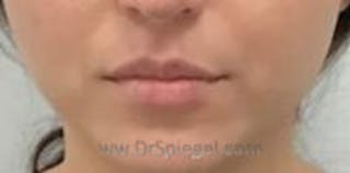 Lip Filler Before & After Gallery - Patient 157140910 - Image 2