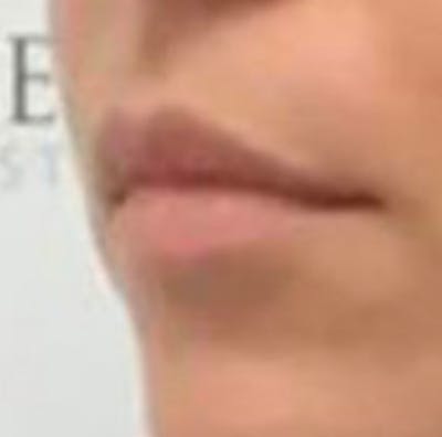 Lip Filler Before & After Gallery - Patient 157140910 - Image 3