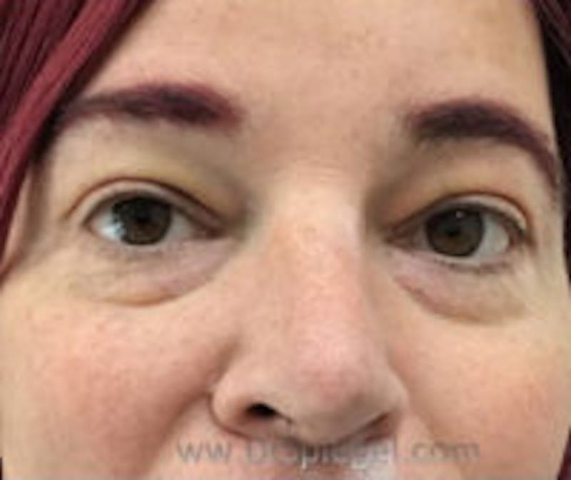 Tear Trough / Under Eye Fillers Before & After Gallery - Patient 157140912 - Image 1