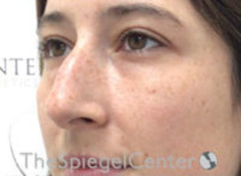 Non-Surgical Rhinoplasty / Nose Filler Before & After Gallery - Patient 157140911 - Image 3