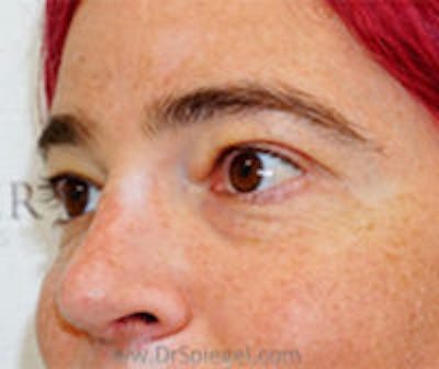 Tear Trough / Under Eye Fillers Before & After Gallery - Patient 157140912 - Image 3