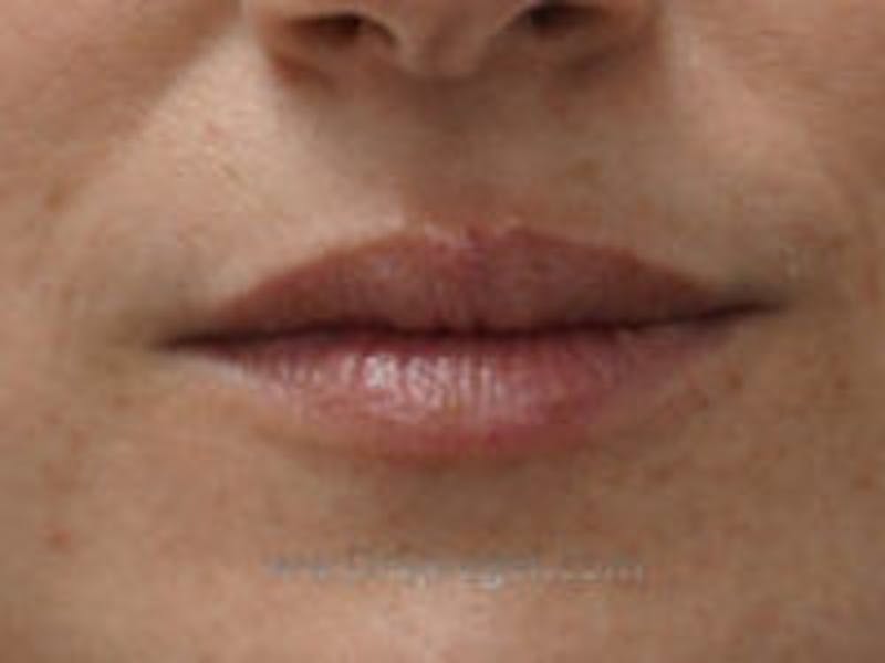 Lip Filler Before & After Gallery - Patient 157140913 - Image 1