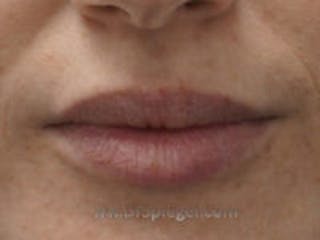 Lip Filler Before & After Gallery - Patient 157140913 - Image 2