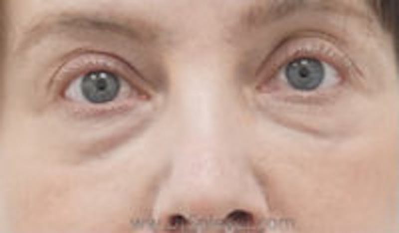 Tear Trough / Under Eye Fillers Before & After Gallery - Patient 157140914 - Image 1