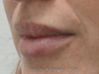 Lip Filler Before & After Gallery - Patient 157140913 - Image 4