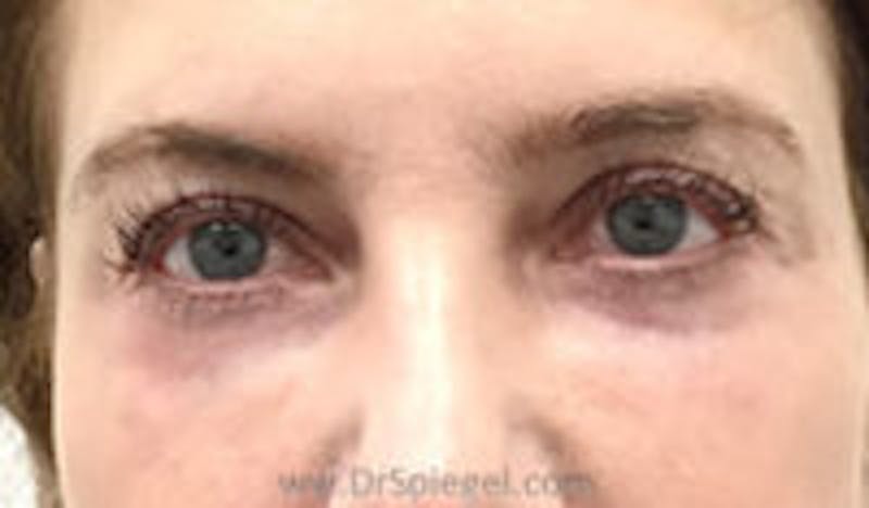 Tear Trough / Under Eye Fillers Before & After Gallery - Patient 157140914 - Image 2