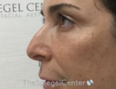 Non-Surgical Rhinoplasty / Nose Filler Before & After Gallery - Patient 157140915 - Image 3