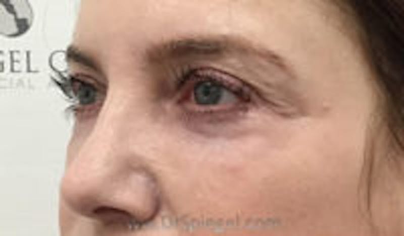 Tear Trough / Under Eye Fillers Before & After Gallery - Patient 157140914 - Image 3