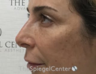 Non-Surgical Rhinoplasty / Nose Filler Before & After Gallery - Patient 157140915 - Image 4