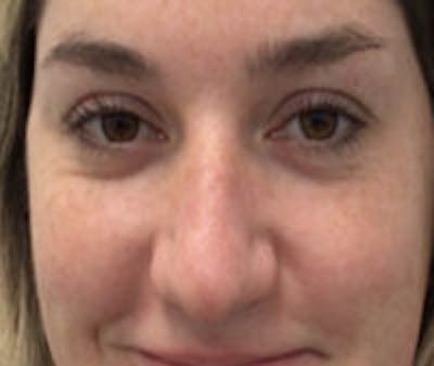 Non-Surgical Rhinoplasty / Nose Filler Before & After Gallery - Patient 157140922 - Image 1