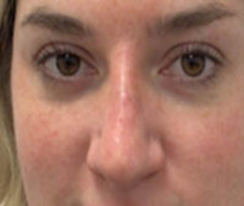 Non-Surgical Rhinoplasty / Nose Filler Before & After Gallery - Patient 157140922 - Image 2