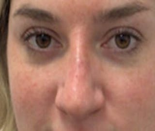 Non-Surgical Rhinoplasty / Nose Filler Before & After Gallery - Patient 157140922 - Image 2