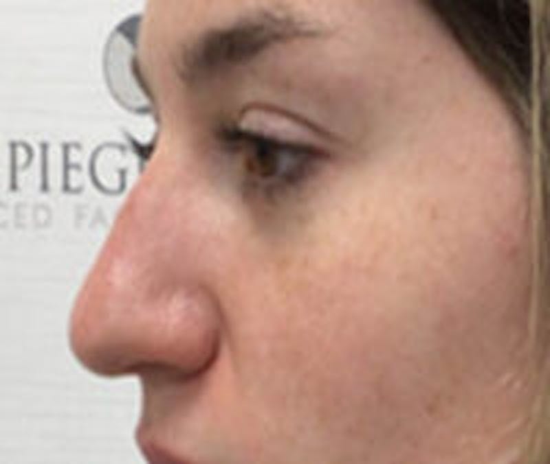 Non-Surgical Rhinoplasty / Nose Filler Before & After Gallery - Patient 157140922 - Image 3