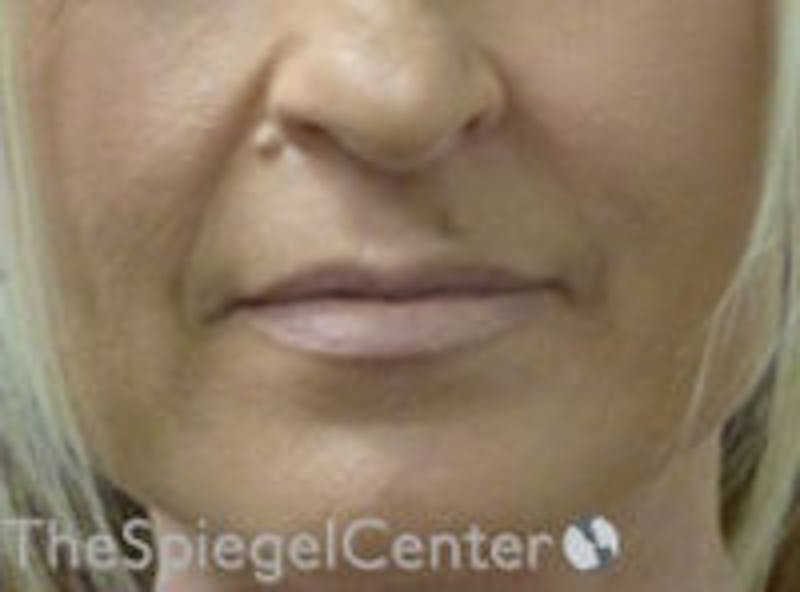 Lip Filler Before & After Gallery - Patient 157140924 - Image 1