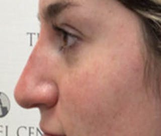 Non-Surgical Rhinoplasty / Nose Filler Before & After Gallery - Patient 157140922 - Image 4