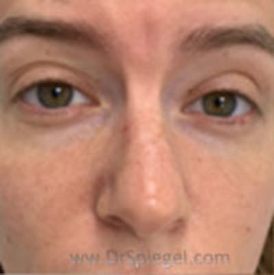 Non-Surgical Rhinoplasty / Nose Filler Before & After Gallery - Patient 157140928 - Image 1