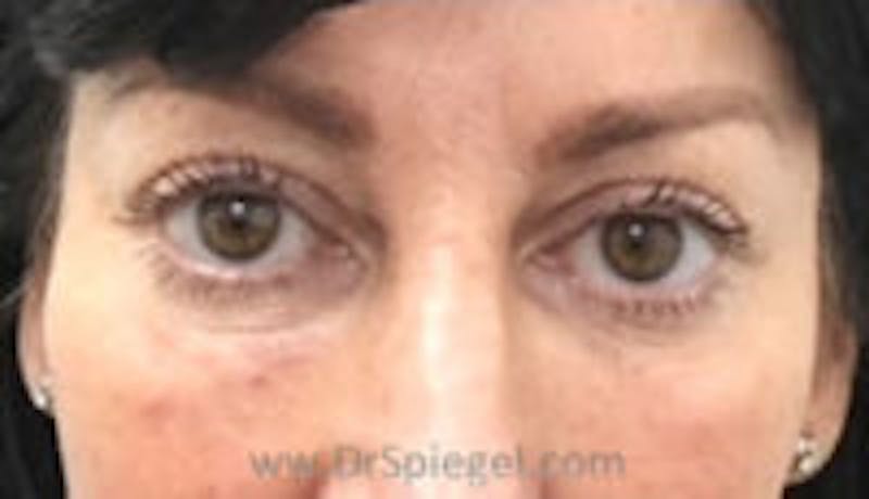 Tear Trough / Under Eye Fillers Before & After Gallery - Patient 157140925 - Image 2