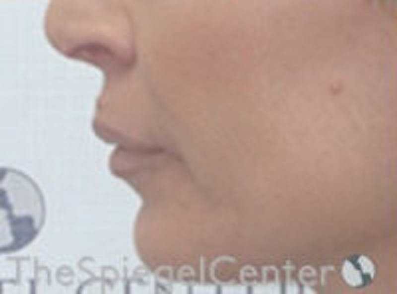 Lip Filler Before & After Gallery - Patient 157140924 - Image 4