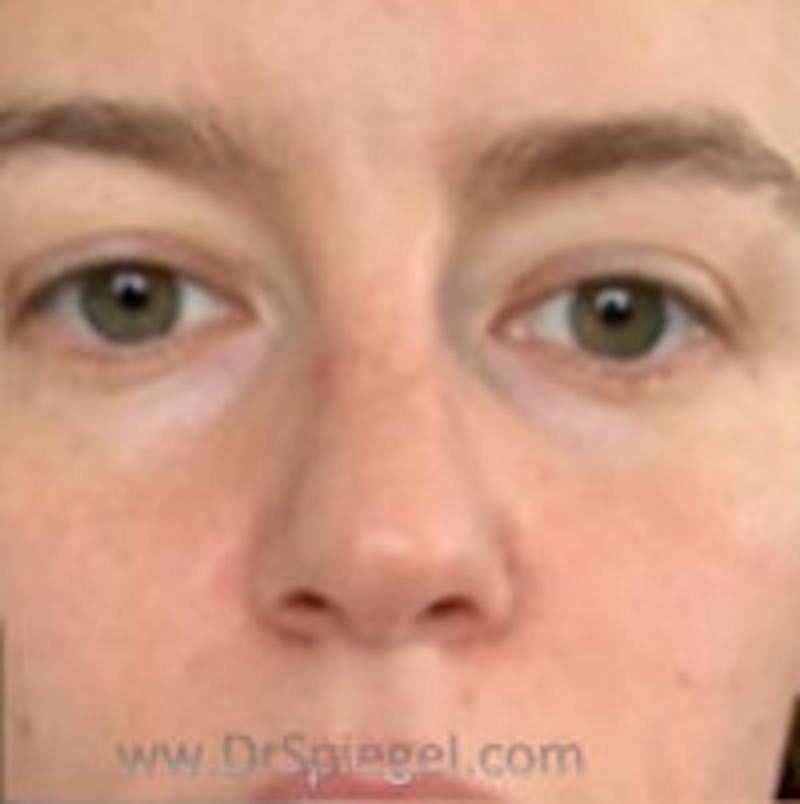 Non-Surgical Rhinoplasty / Nose Filler Before & After Gallery - Patient 157140928 - Image 2