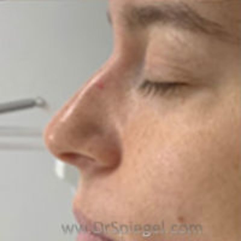 Non-Surgical Rhinoplasty / Nose Filler Before & After Gallery - Patient 157140928 - Image 3