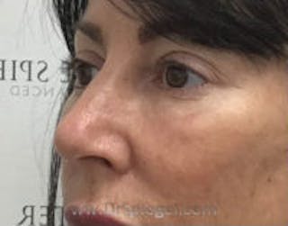 Tear Trough / Under Eye Fillers Before & After Gallery - Patient 157140925 - Image 4
