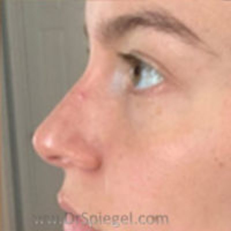 Non-Surgical Rhinoplasty / Nose Filler Before & After Gallery - Patient 157140928 - Image 4