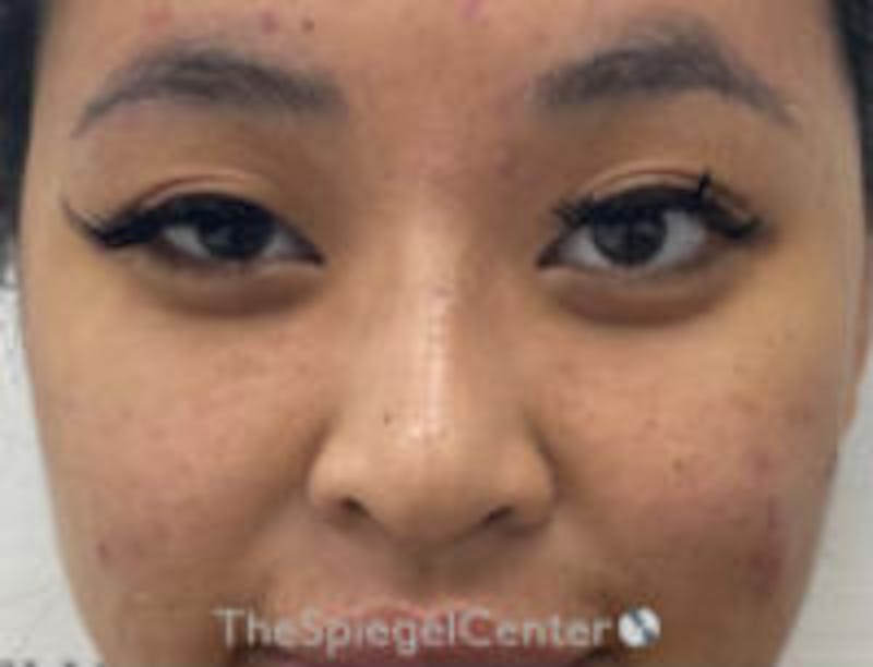 Non-Surgical Rhinoplasty / Nose Filler Before & After Gallery - Patient 157140932 - Image 2