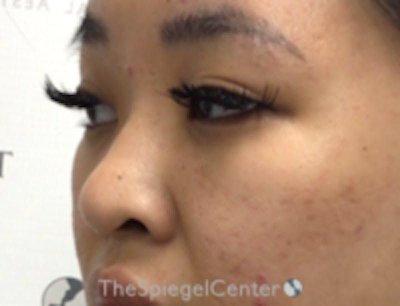 Non-Surgical Rhinoplasty / Nose Filler Before & After Gallery - Patient 157140932 - Image 3