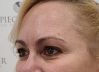 Tear Trough / Under Eye Fillers Before & After Gallery - Patient 157140931 - Image 4
