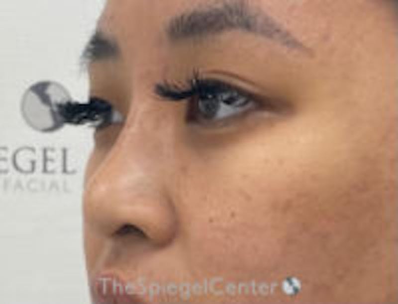 Non-Surgical Rhinoplasty / Nose Filler Before & After Gallery - Patient 157140932 - Image 4