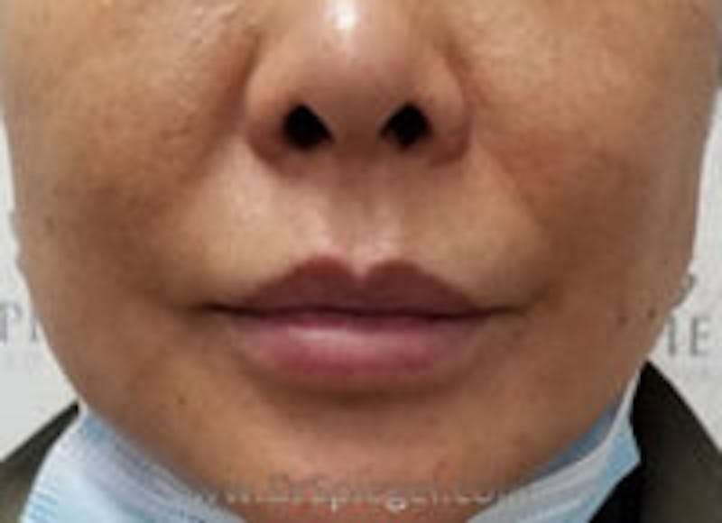 Lip Filler Before & After Gallery - Patient 157140933 - Image 2