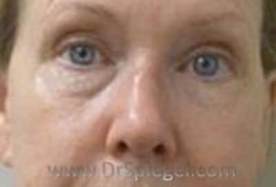 Tear Trough / Under Eye Fillers Before & After Gallery - Patient 157140934 - Image 1