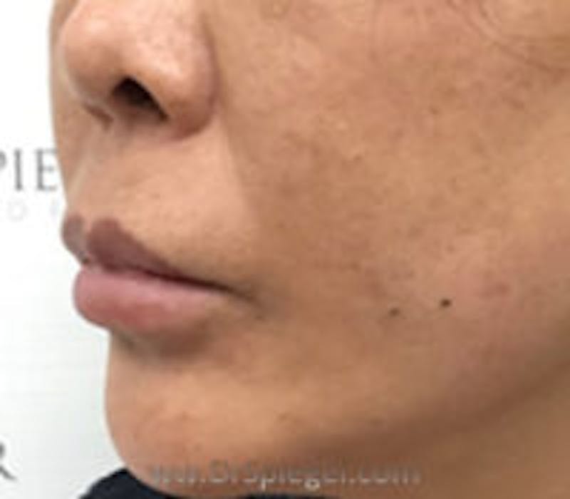 Lip Filler Before & After Gallery - Patient 157140933 - Image 3