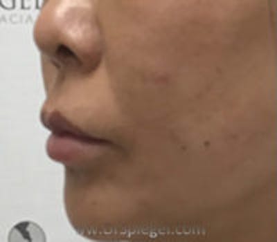 Lip Filler Before & After Gallery - Patient 157140933 - Image 4