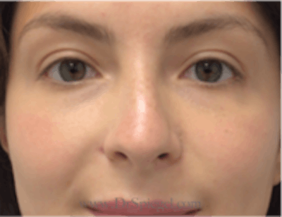 Non-Surgical Rhinoplasty / Nose Filler Before & After Gallery - Patient 157140935 - Image 1
