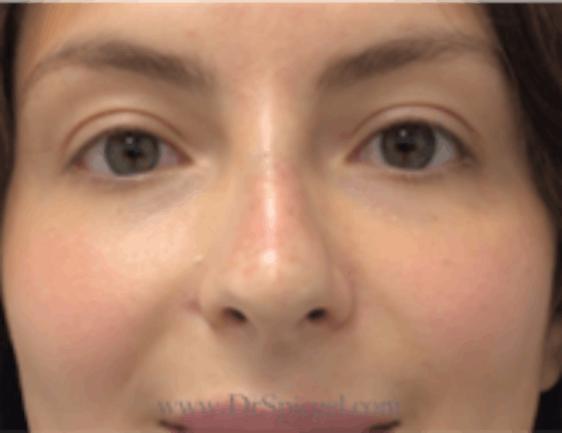 Non-Surgical Rhinoplasty / Nose Filler Before & After Gallery - Patient 157140935 - Image 2