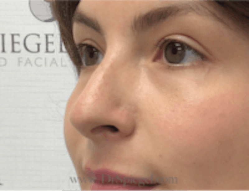 Non-Surgical Rhinoplasty / Nose Filler Before & After Gallery - Patient 157140935 - Image 3