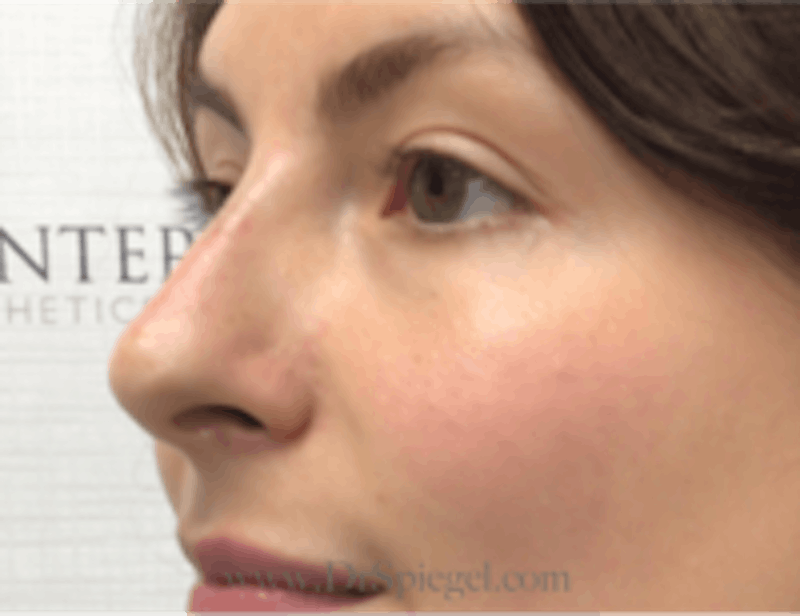 Non-Surgical Rhinoplasty / Nose Filler Before & After Gallery - Patient 157140935 - Image 4