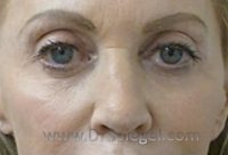 Tear Trough / Under Eye Fillers Before & After Gallery - Patient 157140938 - Image 1