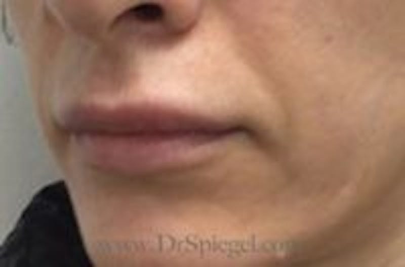 Lip Filler Before & After Gallery - Patient 157140936 - Image 4