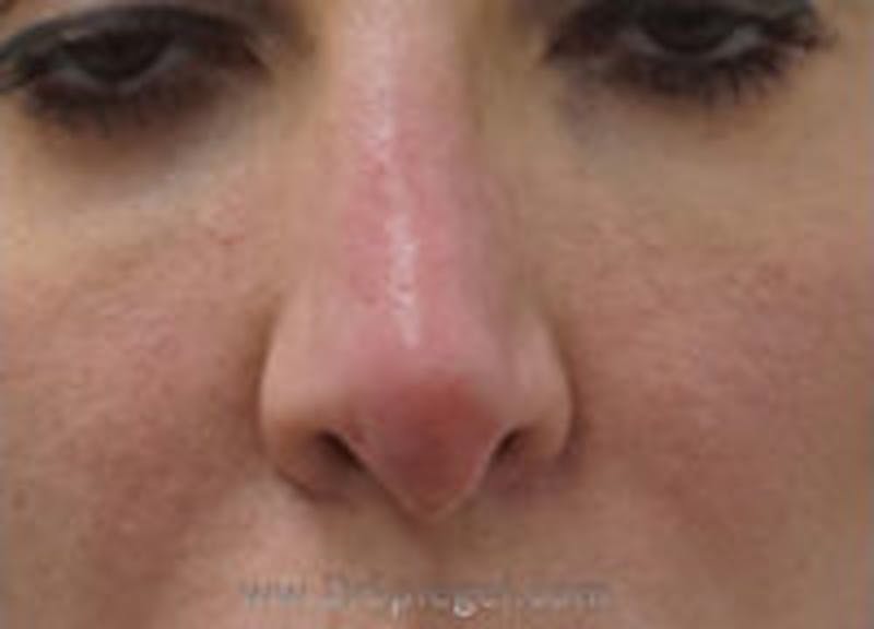 Non-Surgical Rhinoplasty / Nose Filler Before & After Gallery - Patient 157140939 - Image 2