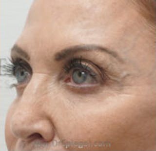 Tear Trough / Under Eye Fillers Before & After Gallery - Patient 157140938 - Image 4