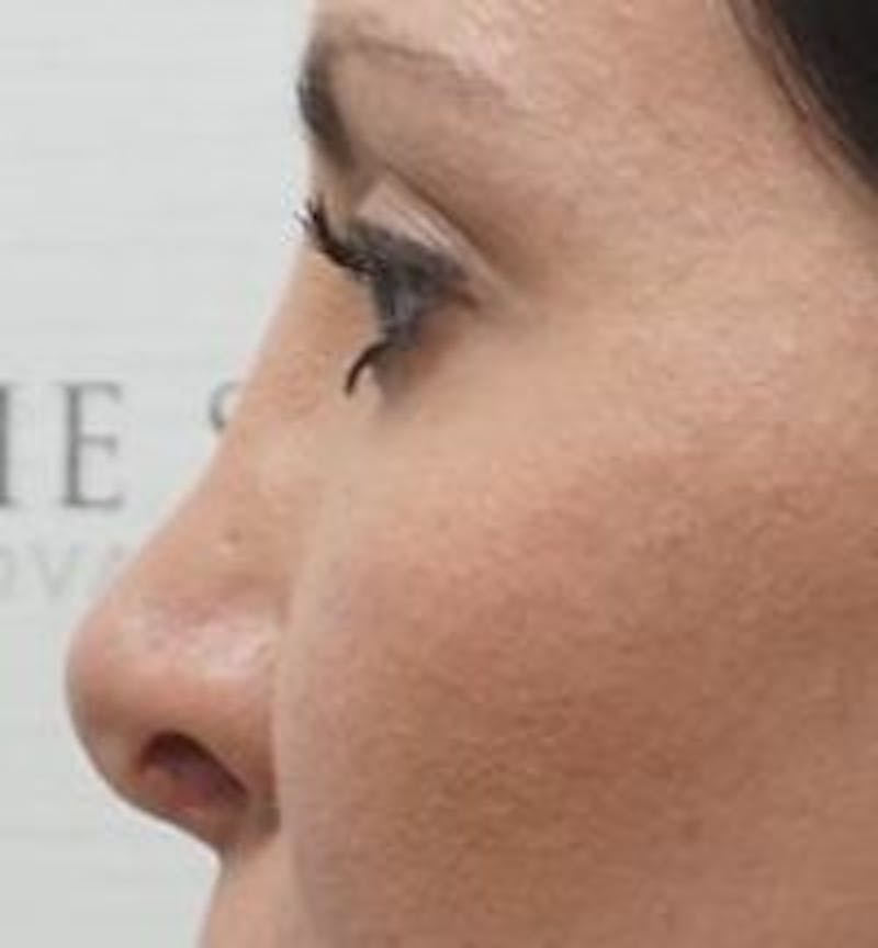 Non-Surgical Rhinoplasty / Nose Filler Before & After Gallery - Patient 157140939 - Image 3