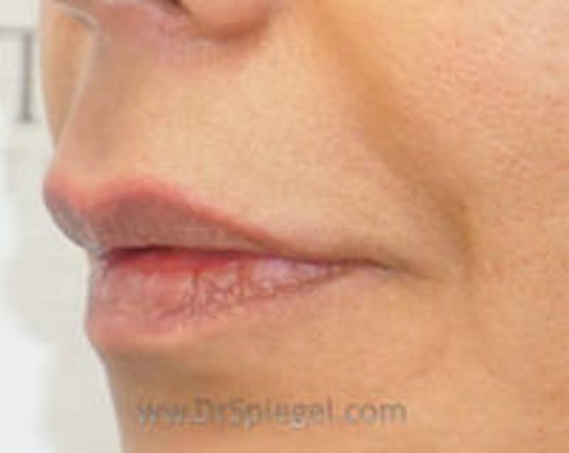 Lip Filler Before & After Gallery - Patient 157140942 - Image 3