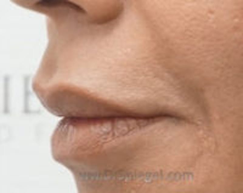 Lip Filler Before & After Gallery - Patient 157140942 - Image 4