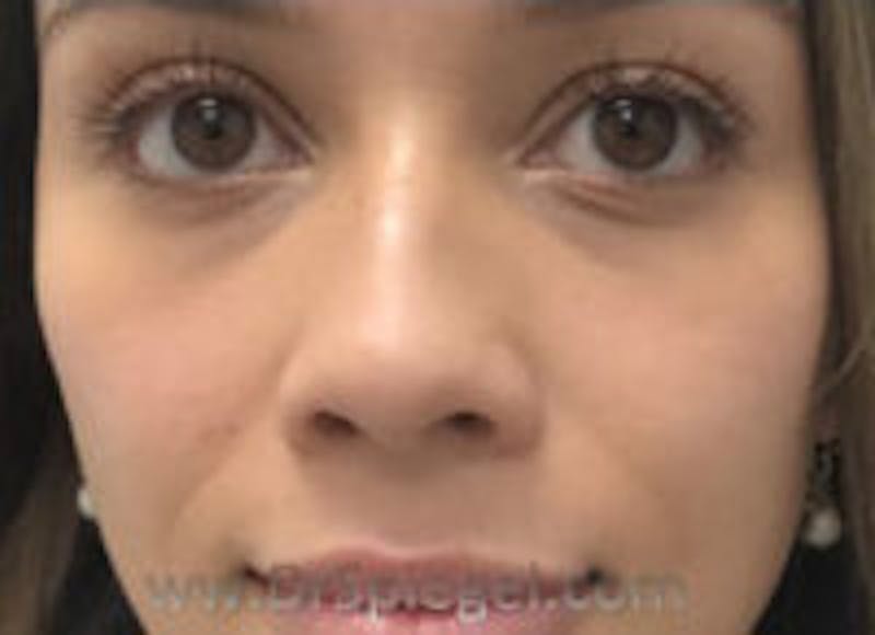 Non-Surgical Rhinoplasty / Nose Filler Before & After Gallery - Patient 157140945 - Image 1